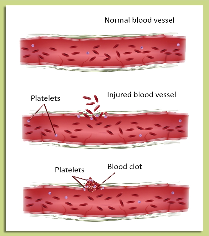 Blood clot